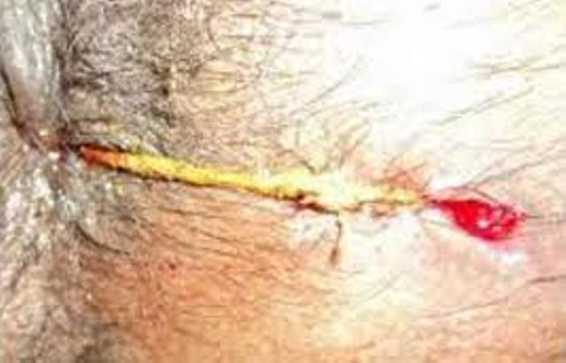 Kashid Hospital Piles Treatment Ahmednagnar